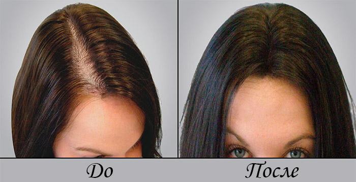 никотиновая кислота для волос фото до и после